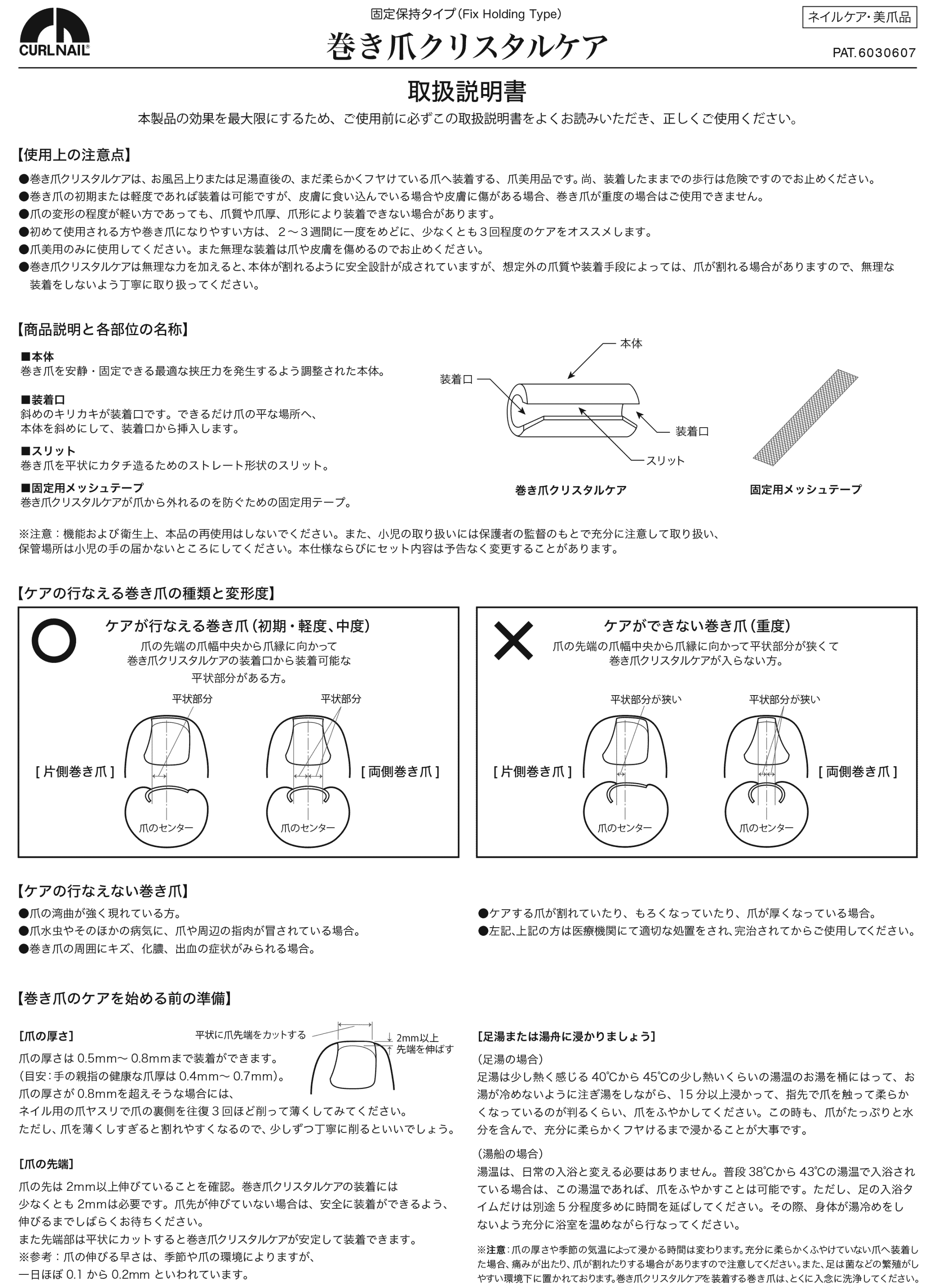 巻き爪矯正