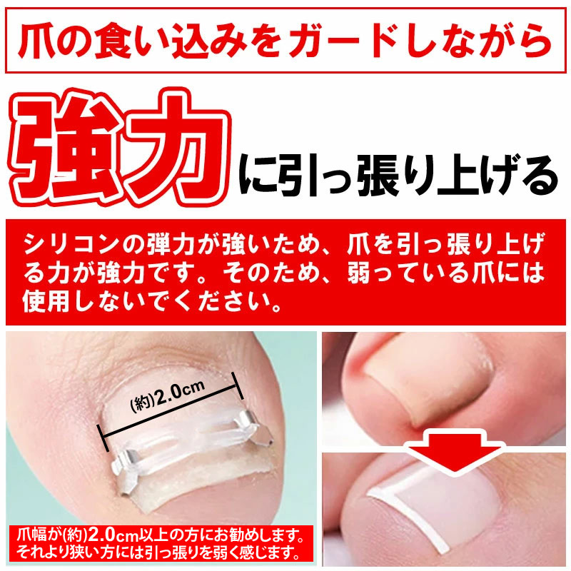 まきづめ 巻き爪 ケア ネイルケア ガード 巻き爪ブロック 巻き爪