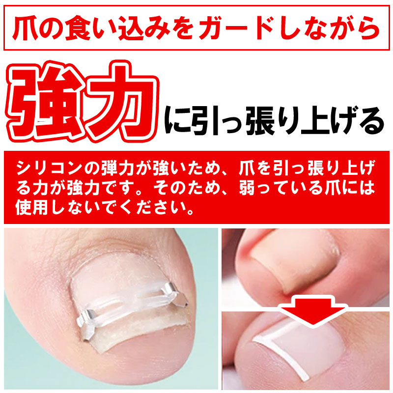 まきづめ 巻き爪 ケア ネイルケア ガード 巻き爪ブロック 巻き爪