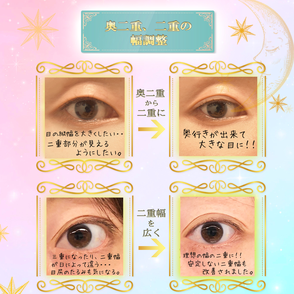 皮膜式二重コスメ くるりんFUTAE本舗 くっつけない二重 皮膜式