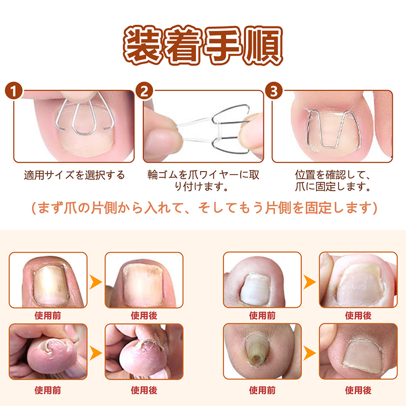 SENUN 巻き爪 矯正 セット ワイヤー 自分で 爪ワイヤー サポート 器具
