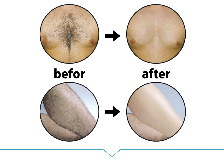 No.1 男性用除毛剤「薬用ONEリムーバー」