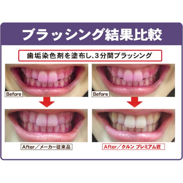 クルンプレミアム 匠 6本セット 歯ブラシ 回転 360度歯ブラシ 超極細毛 歯周ケア ロールブラシ 歯ぐき用 はぶらし 歯ぶらし ハブラシ クルン歯ブラシ  正規品 :kurunpremium:BodySoul - 通販 - Yahoo!ショッピング