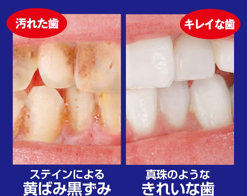 歯の美白ホワイトニング 口臭予防 薬用重曹ステインプロ 医薬部外品 :014-002-3687:いぶりん商店 - 通販 - Yahoo!ショッピング