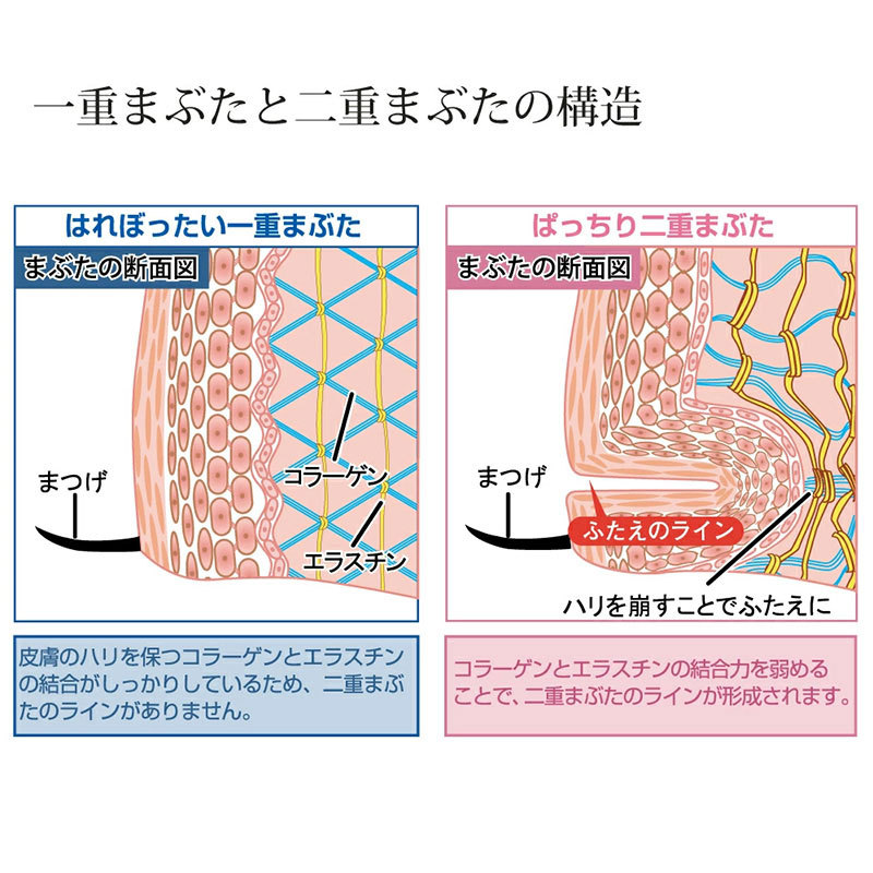ふたえまぶた形成器 NEW アイリッドフォールド 二重 眼瞼下垂 アイ