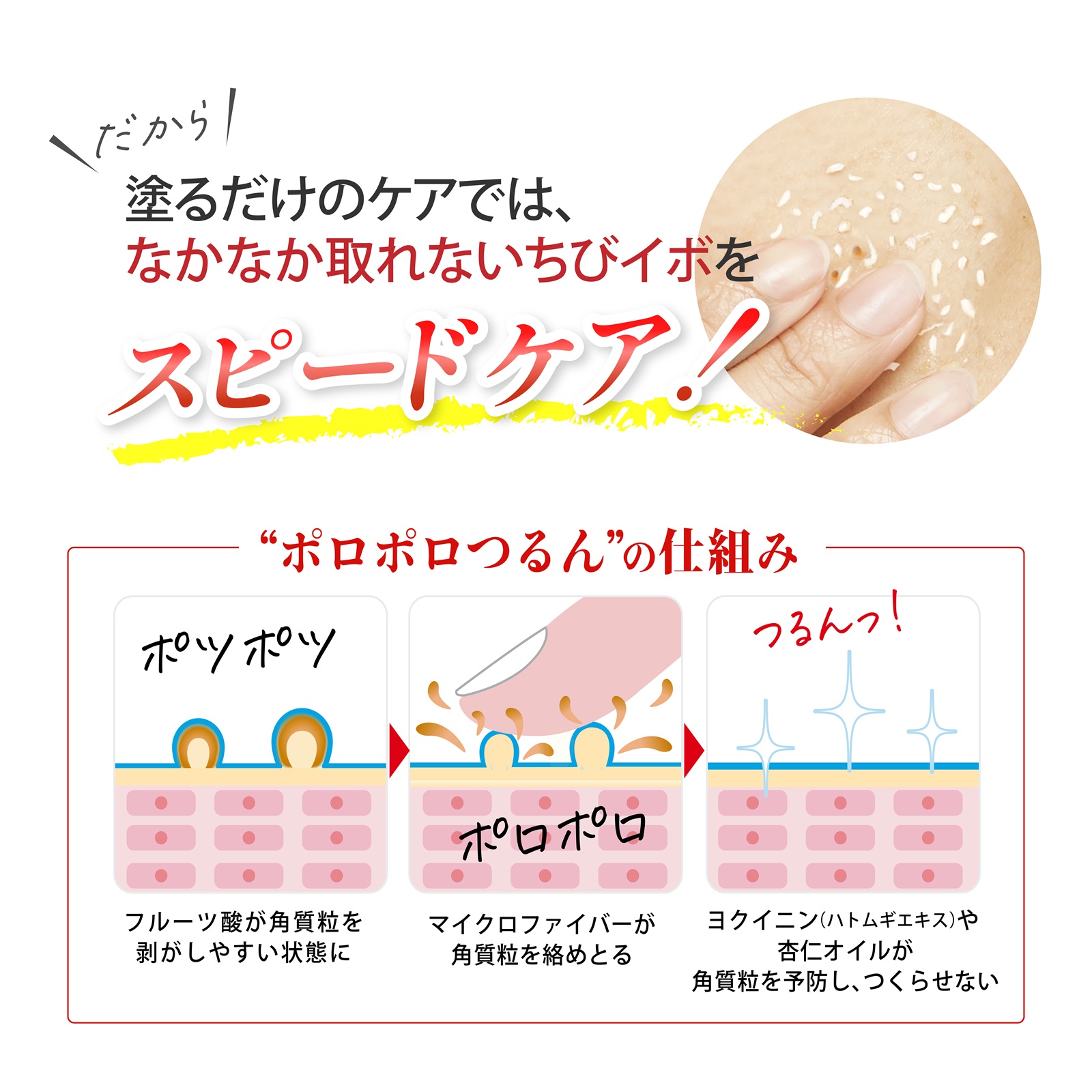 イボ取り ピーリング 首イボ 除去 ヨクイニン 薬用 クリーム ジェル ハトムギ 角質粒取り 首 首 顔 胸元 ピーリングスムーサーEXW 爆買