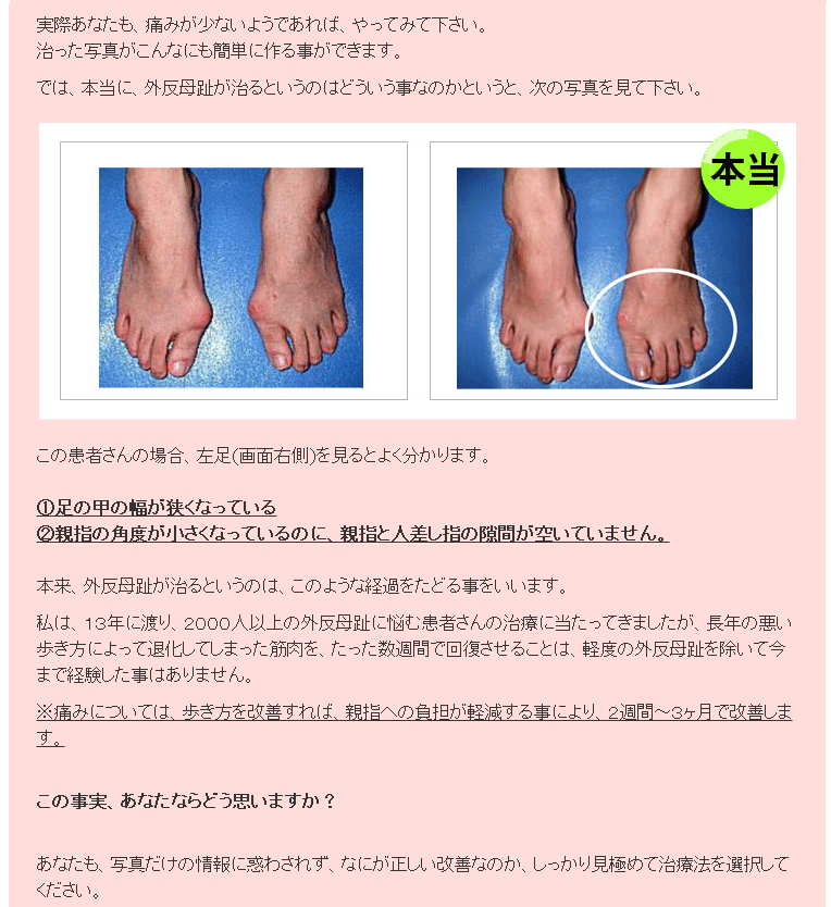 最安値に挑戦 古屋式 外反母趾改善dvd 大注目 Homeofmalones Com