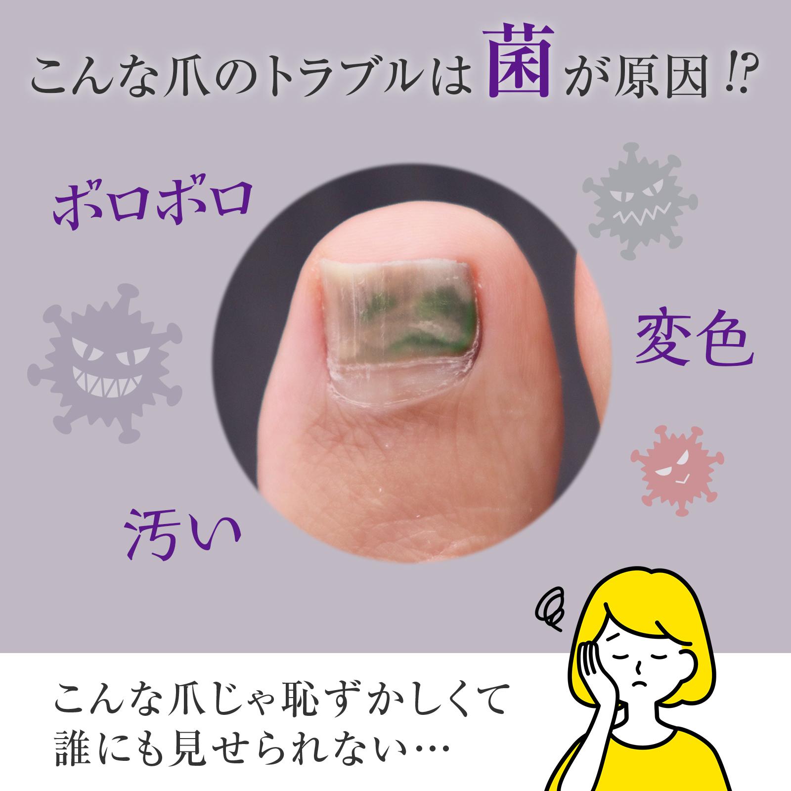ビューナ 薬用足爪きれいα 指定医薬部外品 クリーム チューブ 爪