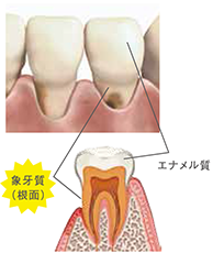 歯根露出画像
