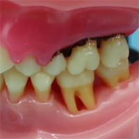 歯周病予防用品
