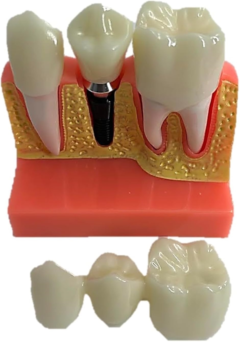 歯模型 歯科用 インプラント模型 歯の模型 解剖学 歯科インプラント