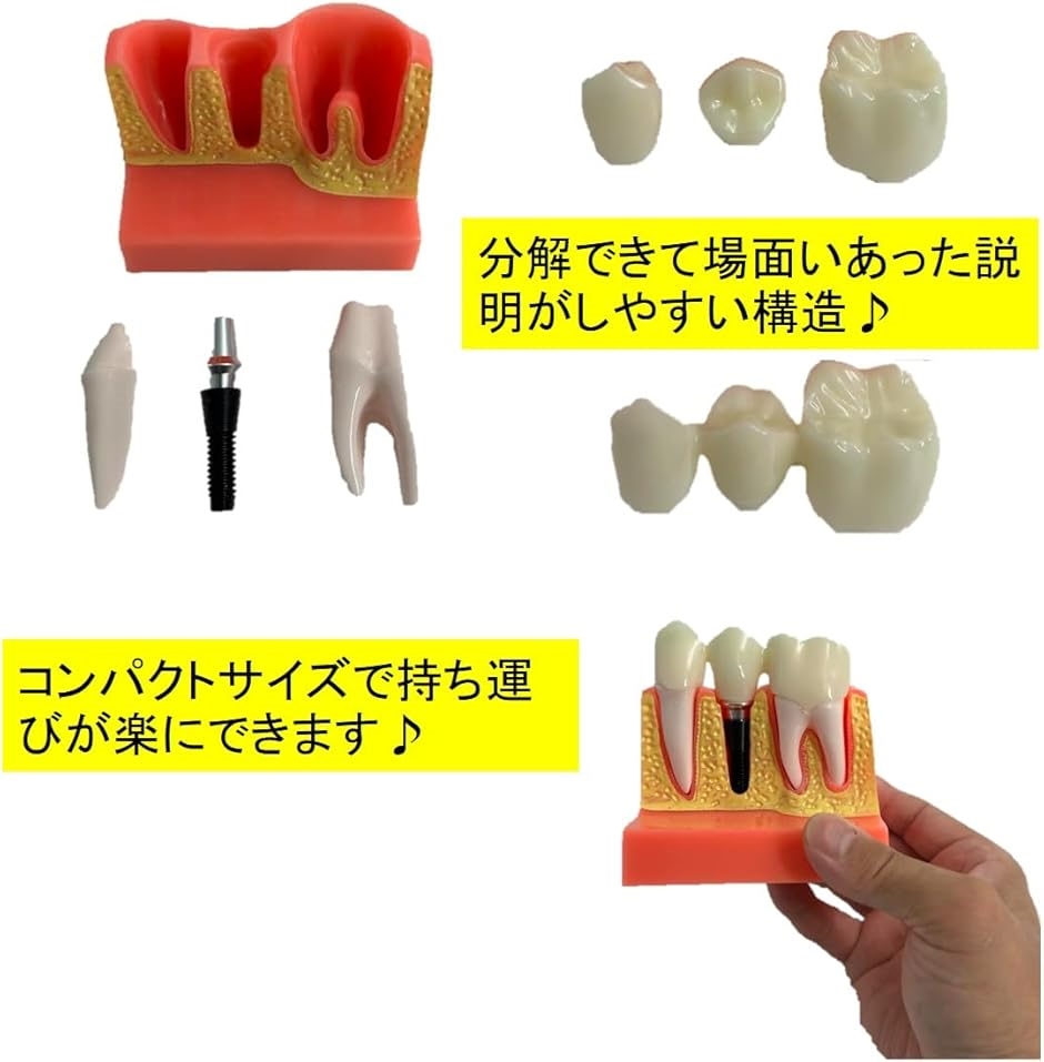 歯模型 歯科用 インプラント模型 歯の模型 解剖学 歯科インプラント