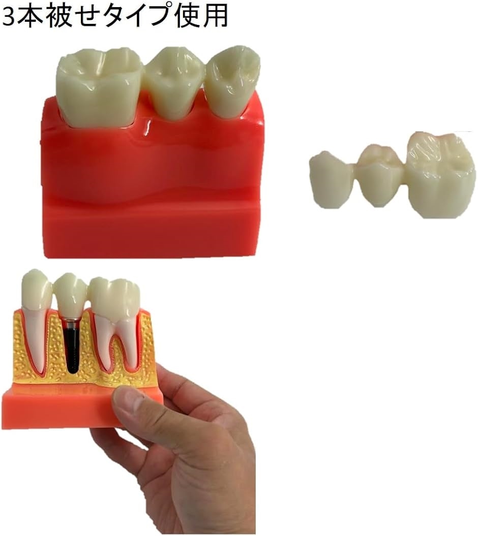 歯模型 歯科用 インプラント模型 歯の模型 解剖学 歯科インプラント