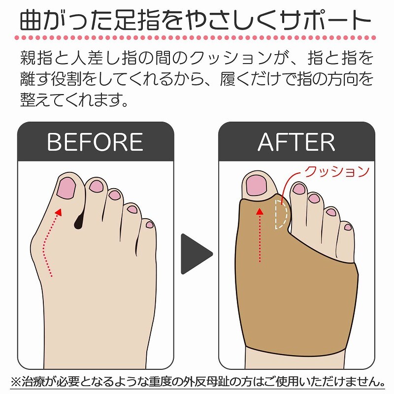 外反母趾サポーター 