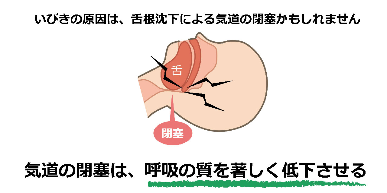 カルイビキ いびき 枕 いびき防止 いびき対策 うつぶせ 睡眠時無呼吸 