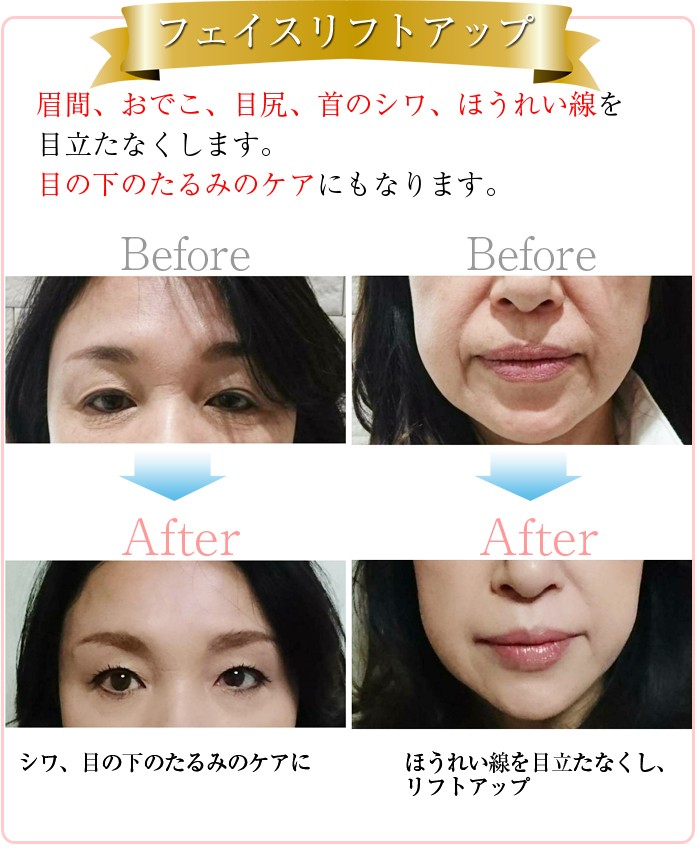 Hifu Mini ハイフ美顔器 家庭用ウルセラ美顔器 高密度焦点式超音波美顔 返品交換可能 ウルセラ ダブロ 美顔器 HIFU 小型 リフトアップ 強力 ハイフ 美容機器