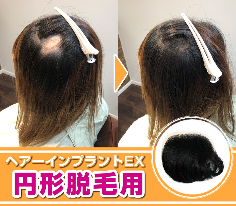 部分ウィッグ　頭皮一体増毛 ヘアーインプラントEX　円形脱毛用　※装着にはテープかシリコンが必要です