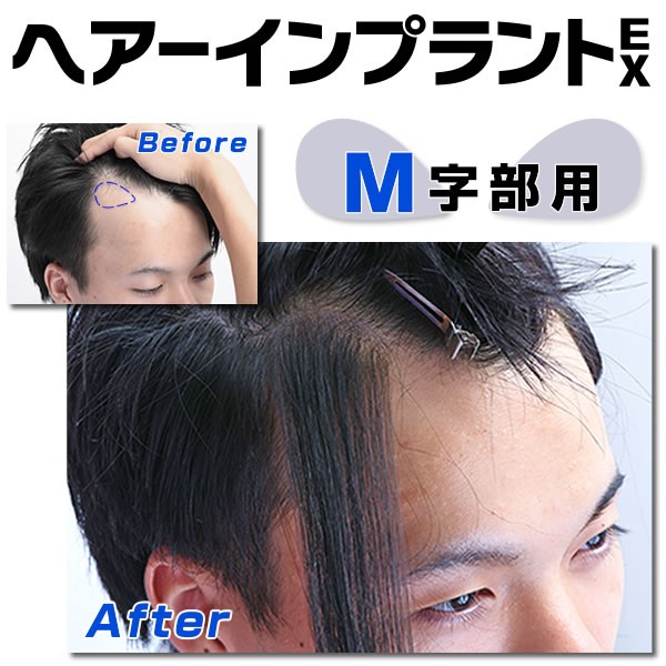 【82%OFF!】 激安正規 部分ウィッグ 頭皮一体増毛 ヘアーインプラントEX Ｍ字部用 かつら kentaro.sakura.ne.jp kentaro.sakura.ne.jp