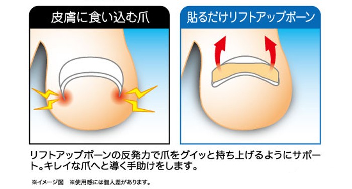 簡単貼るだけ Dr.巻き爪テープ 巻き爪 治療 巻き爪 テープ 巻き爪 巻き爪 テーピング 爪 シール 足