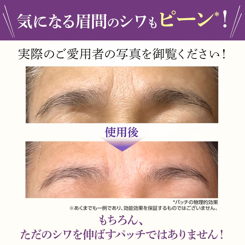北の快適工房 公式 ミケンディープパッチ 眉間 刺す ヒアルロン