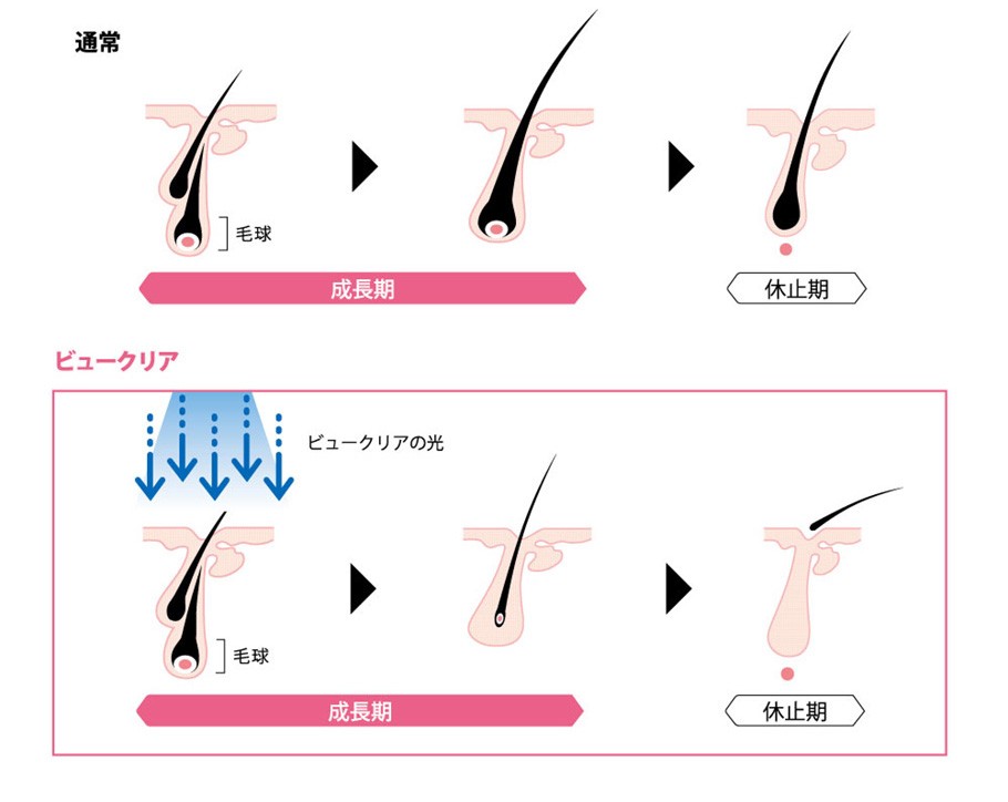 脱毛器 VIO アデランス ビュークリア ムダ毛 脱毛 光脱毛 脱毛機 IPL フラッシュ脱毛器 家庭用 メンズ ひげ 女性 ラッピング