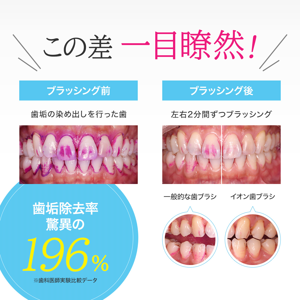 KISS YOU（IONIC） 音波振動歯ブラシ IONPA home （イオンパ