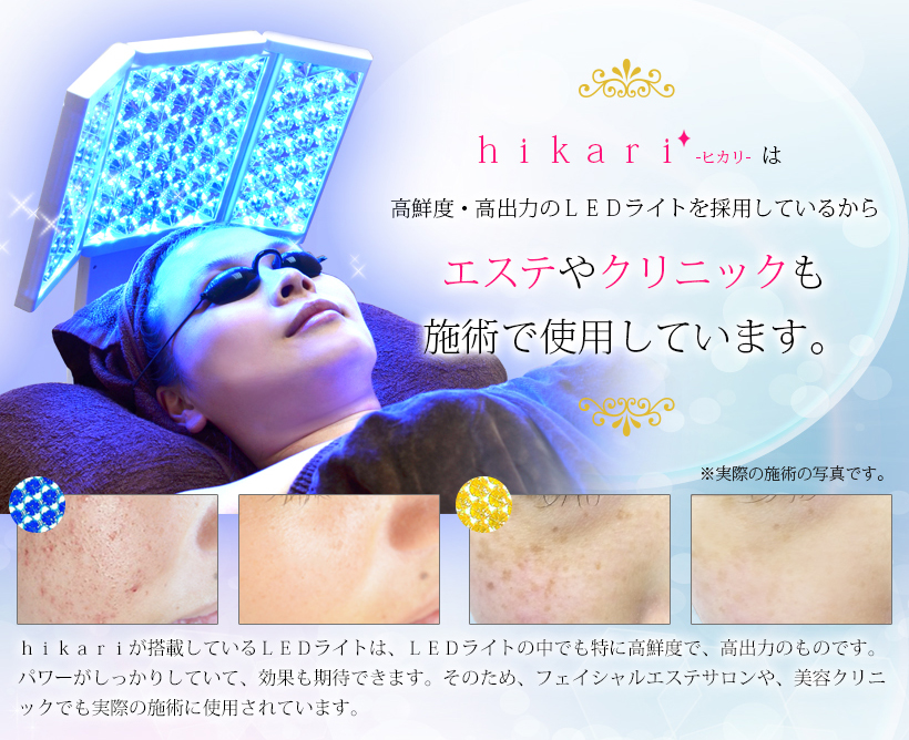 belulu 【美ルル ヒカリ】美顔器 シミ取り トータルケア 光美容器 赤色