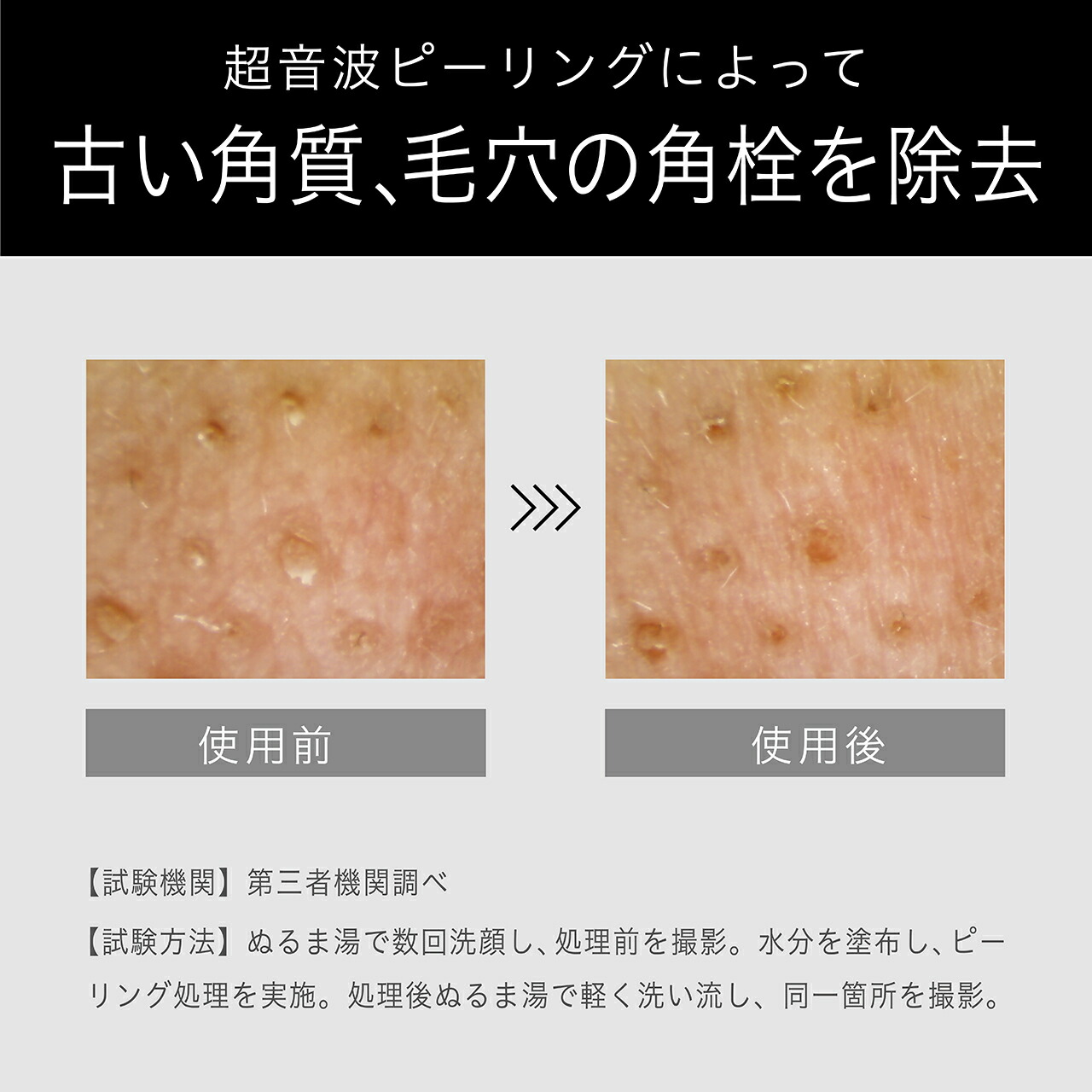 【メーカー公式】エナージュ ピーリング＆超音波美顔器 KBE-2740 | 超音波による汚れ除去\u0026うるおい浸透の2WAYケア  KBE2740K||の画像