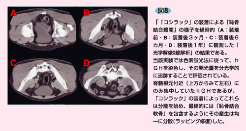 腰痛ガードル【コシラック・ショートガードル＋ワンベルト お得セット