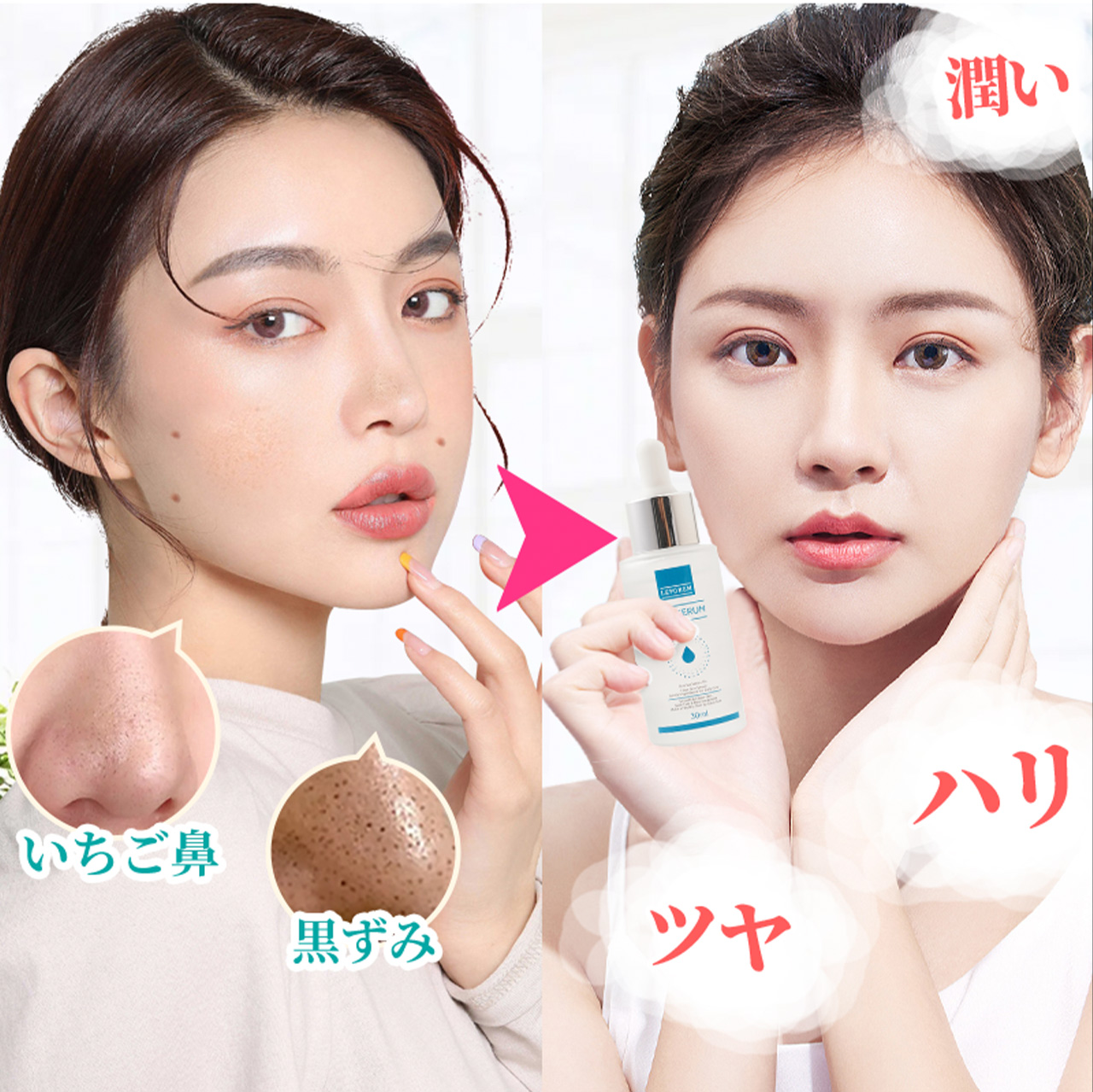 2点、Rセラム、ヒアル アゼライン酸ACセラム 30ml にきび 美容液 赤ら顔 酒さ グリシル