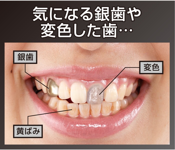 デンタルパール 3ml 歯を白くする方法 簡単 歯のホワイトニング 銀歯 