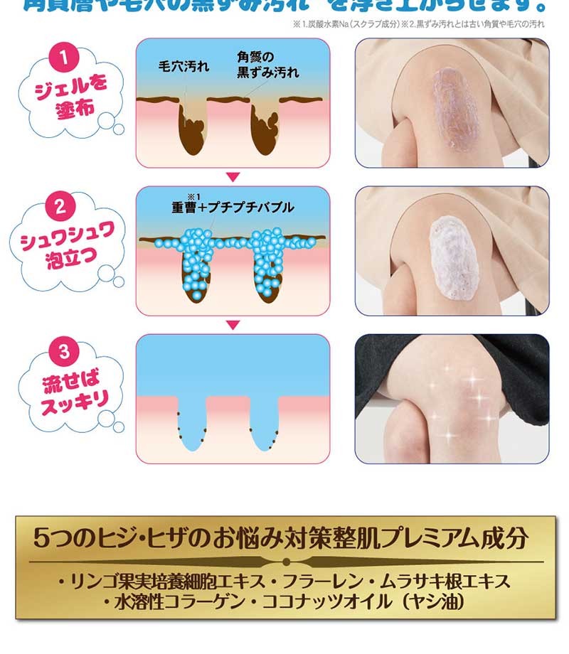 アトネールex 足パック 古い角質取り 茶痕 黒ズミ 黒ずみ 踝 お悩みに 摩擦の茶アト サポート 足 くるぶし 角質硬化 ボディクリーム