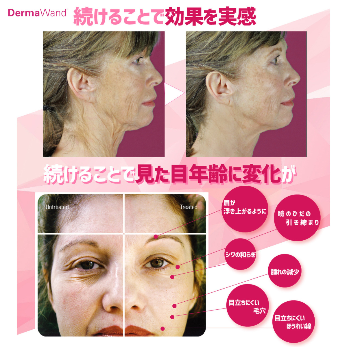 RF美顔器 リフトアップ ダーマワンド Derma Wand スチーマー EMS KNS 