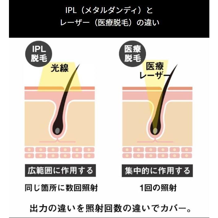 おすすめポイント メタルダンディ メンズ光脱毛器 - 美容/健康