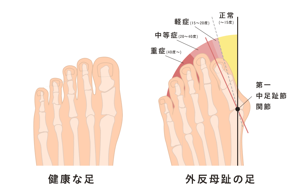 外反母趾に優しい靴の選び方