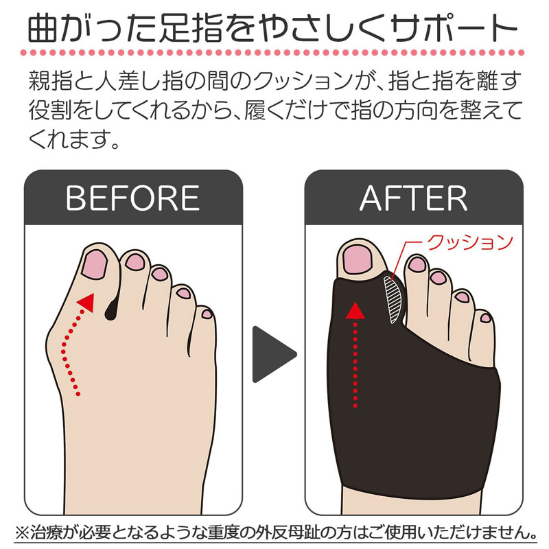 外反母趾サポーター 