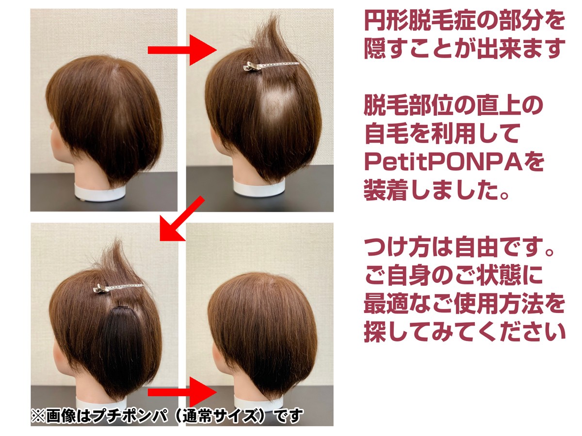 ピンポイント部分ウィッグPetit PON-PA LONG（プチポンパ ロング）なら円形脱毛のカバーに最適です