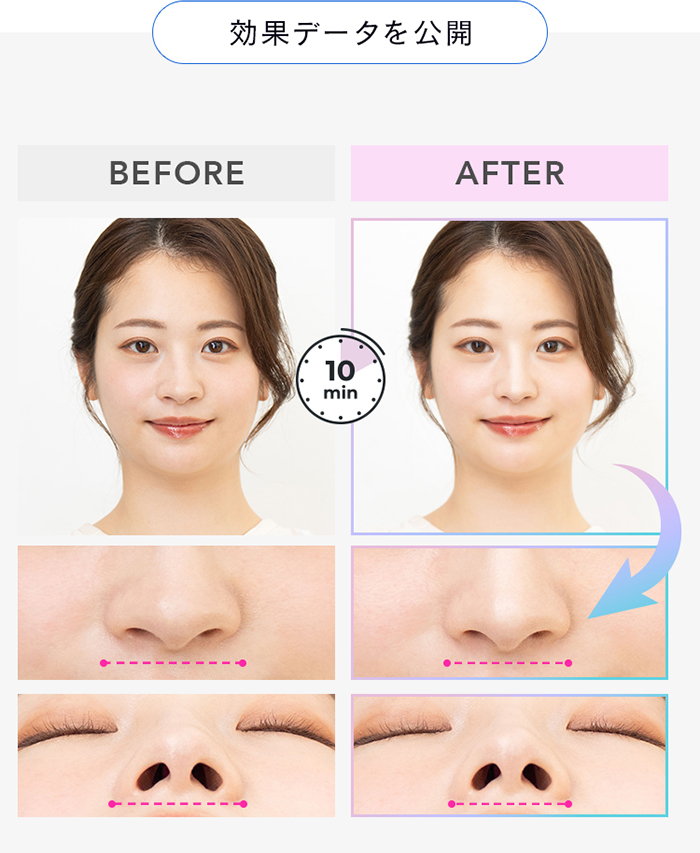 LUXCEAR（ルクセア） LUXCEAR Fornez PRO フォーネス プロ 鼻 美顔器