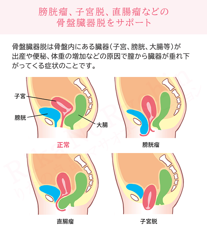 膀胱瘤、子宮脱、直腸瘤などの骨盤臓器脱をサポート
