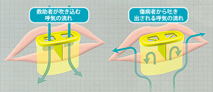 傷病者からの呼気などの逆流を防止