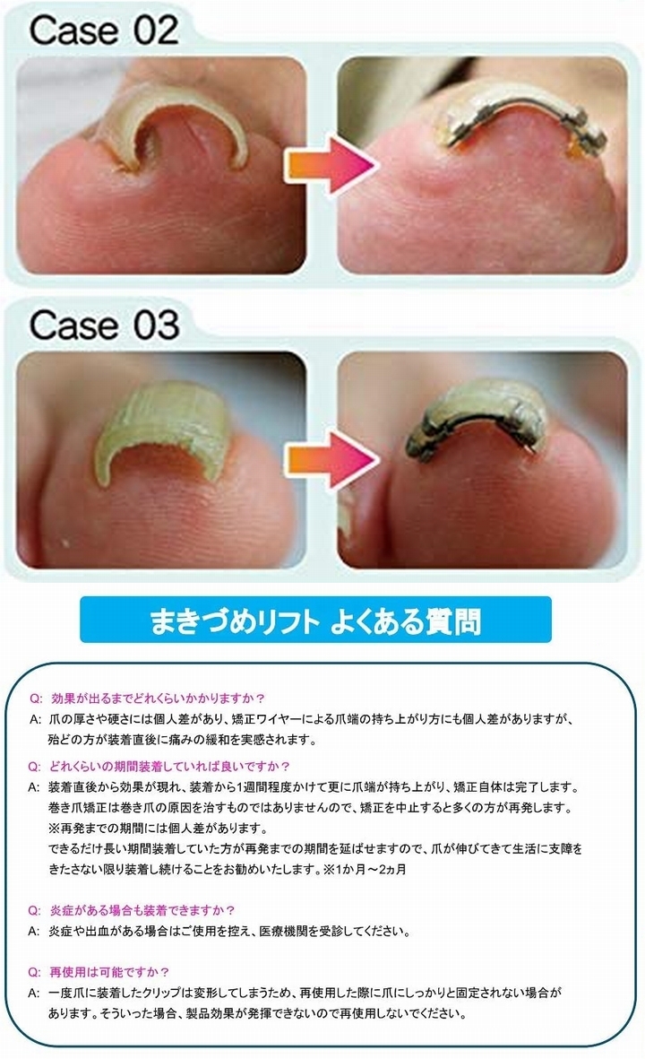 4個セット　JPS まきづめリフト 専用爪ヤスリ付き Amazon.co.jp：JPS(ジェイピーエス) まきづめリフト(ヤスリ付き