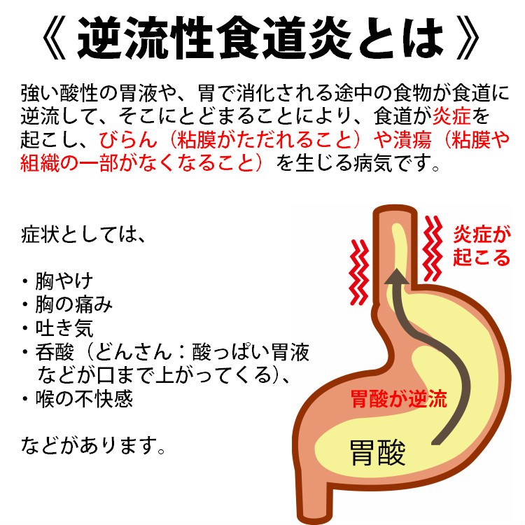 胃酸過多 エスマーゲン 60包 逆流性食道炎 飲み過ぎ 胸やけ 膨満感