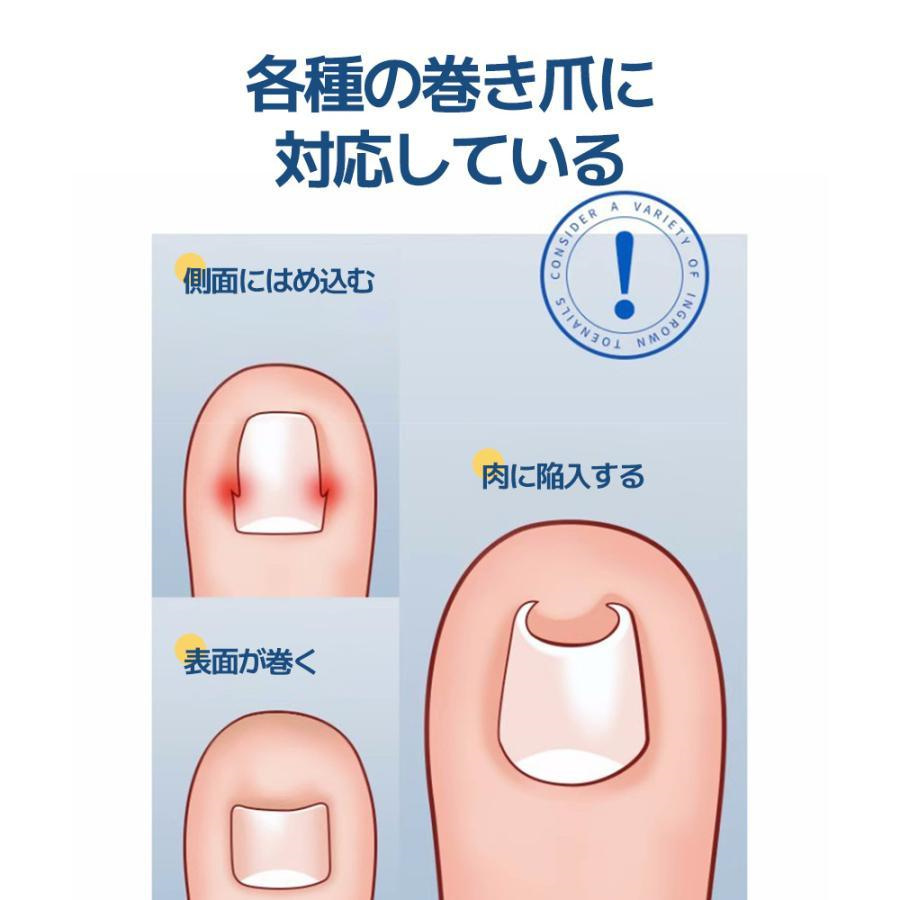 2個セット 巻き爪 矯正 器具 マキちゃんセット 自分で治す方法 巻き爪