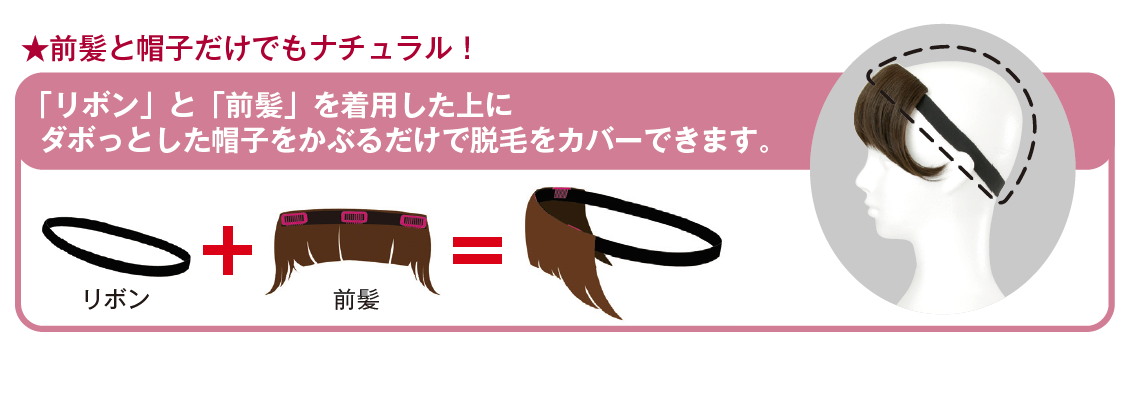 前髪だけで脱毛をカバー