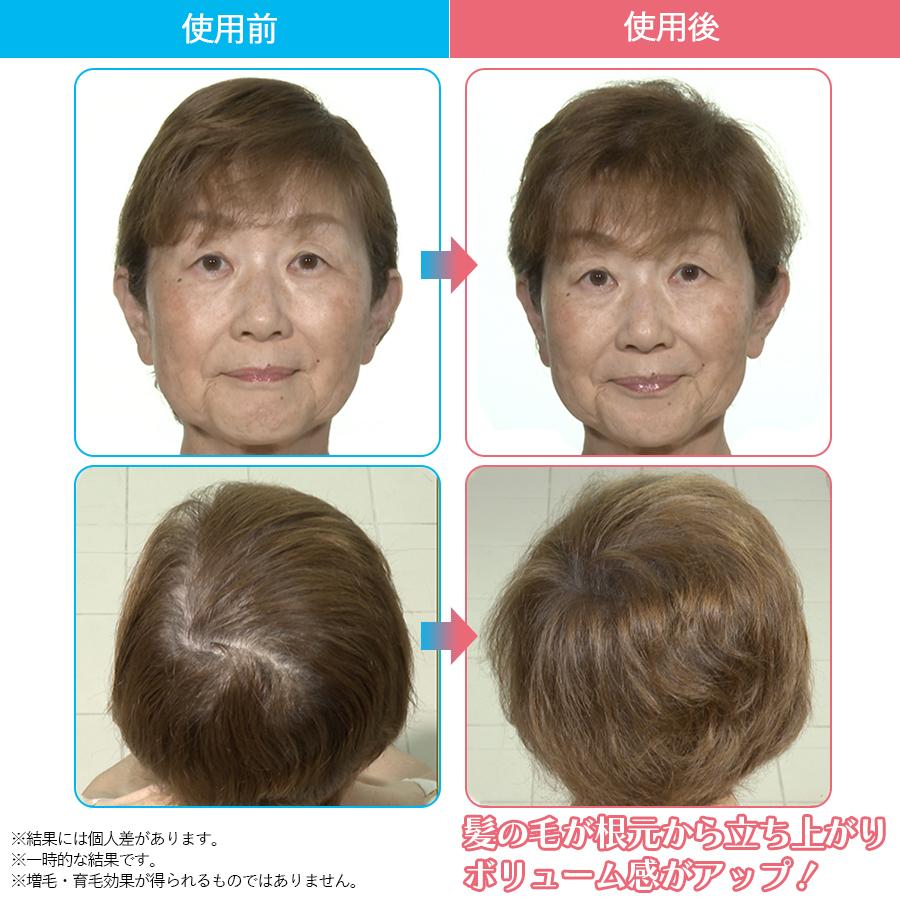 NIPLUX（ニップラックス） EMS ヘッドスパ / TBS特別セット ヘッド