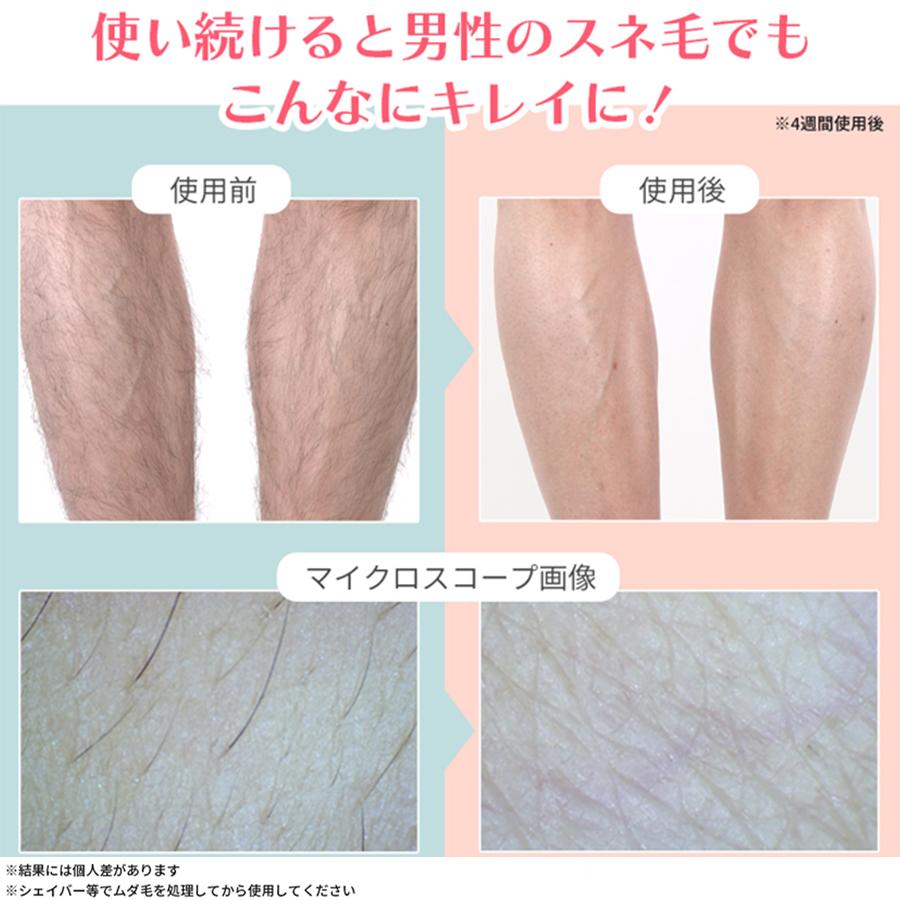 CQ クリニカルエピプロフェッショナル / ムダ毛ケアアイテム