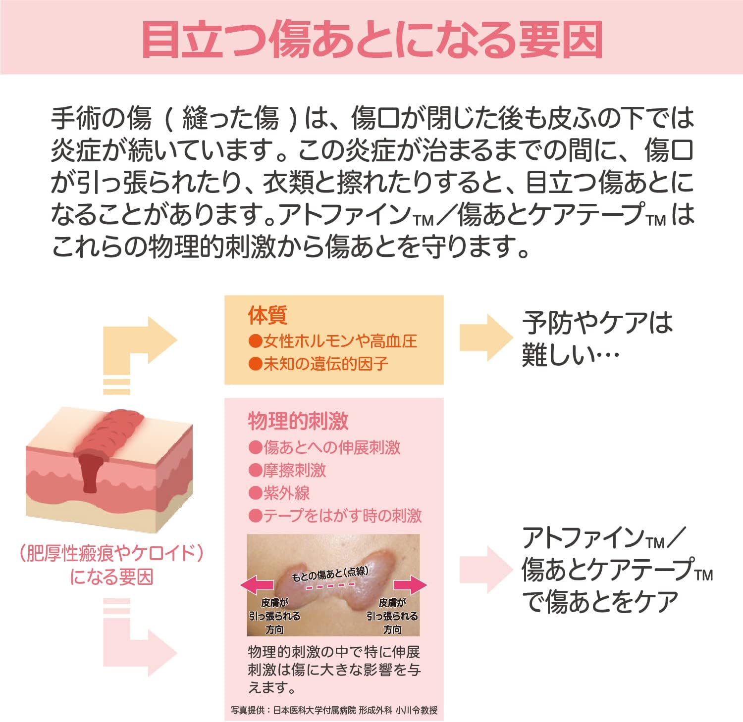 ニチバン アトファイン SS 2個セット 帝王切開の傷 手術後の傷 傷あとケア ケアテープ Atofine | アトファイン | 03