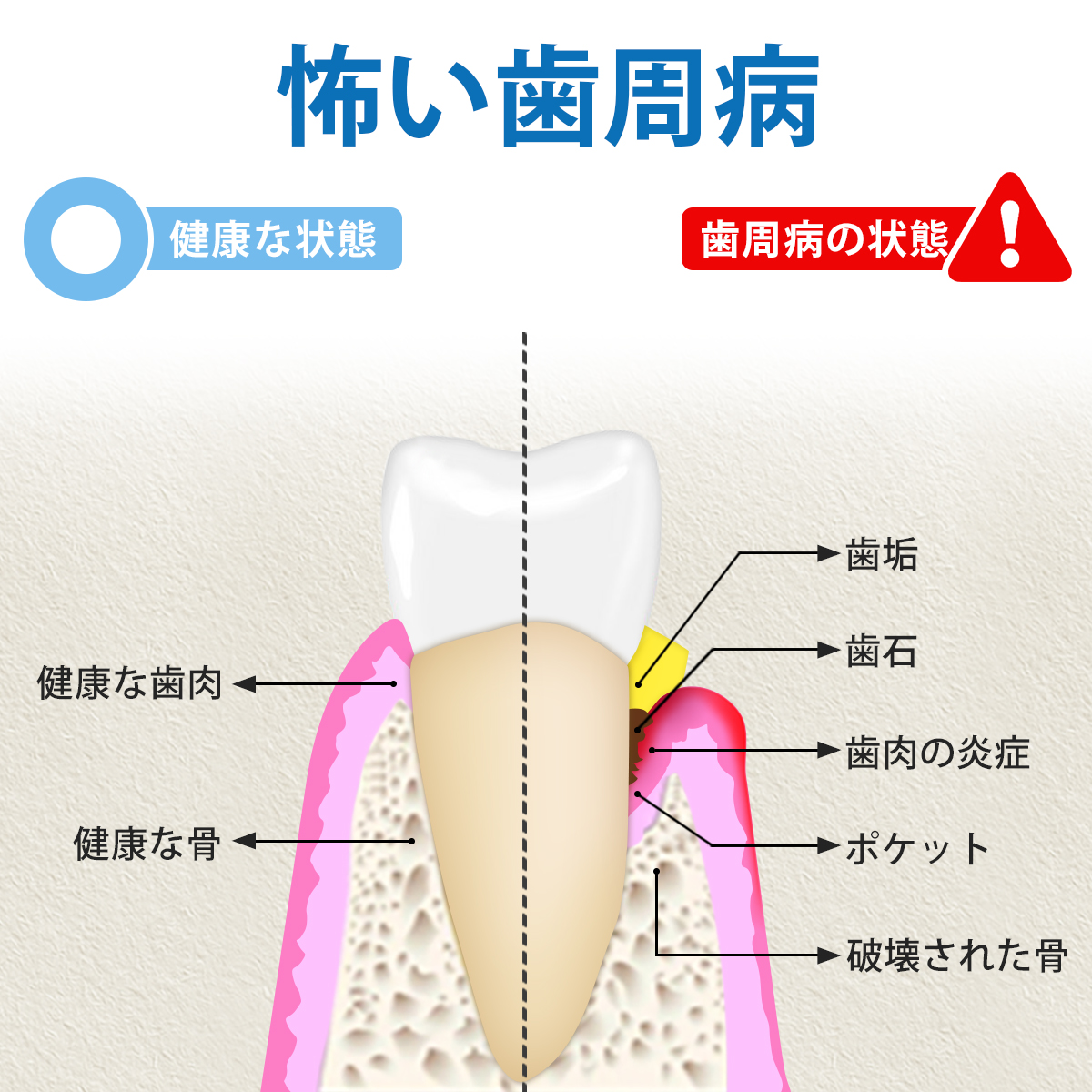 応援特価! 最新 2色発光 デンタルミラー ledライト 歯石取り 口 鏡 歯 歯鏡 歯科 ミラー 曇り止め 歯垢 チェック 口腔ケア 口臭予防 歯周病 介護 関連画像1