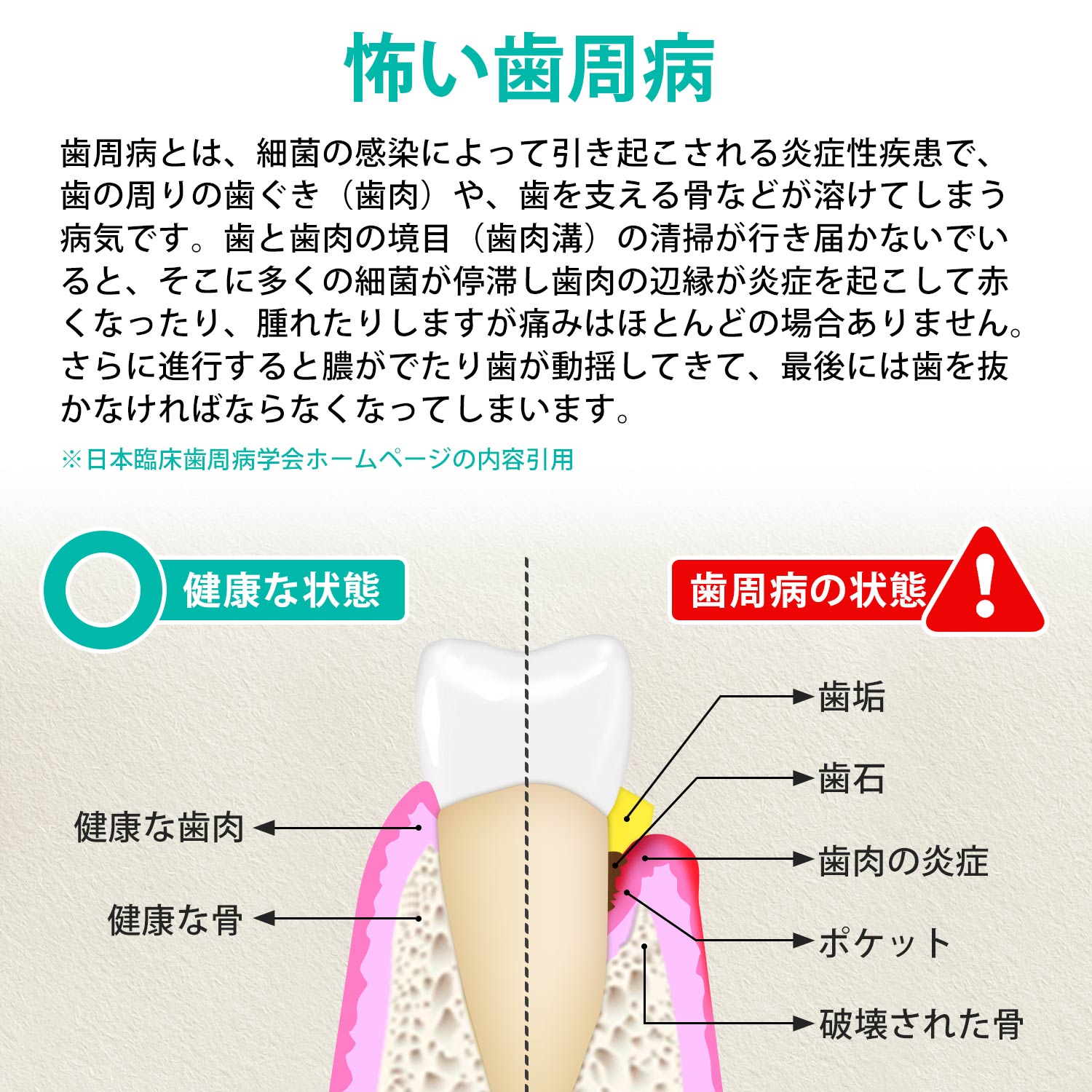 応援特価! 医療認証品 歯石取り スケーラー 歯石 スケーラー 歯 歯石除去 5点セット 自宅 デンタルケア 虫歯 予防 歯垢 歯鏡 口腔ケア ケース付 関連画像4