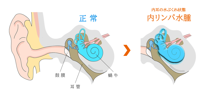 携帯用鼓膜按摩器Clearクレア